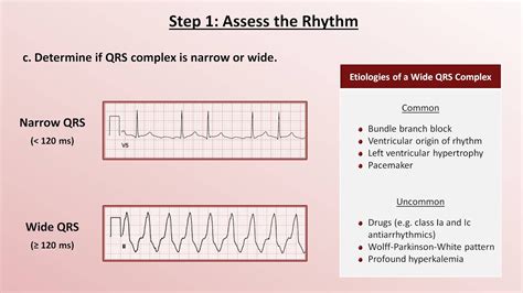 Intro to EKG Interpretation - A Systematic Approach | Doovi