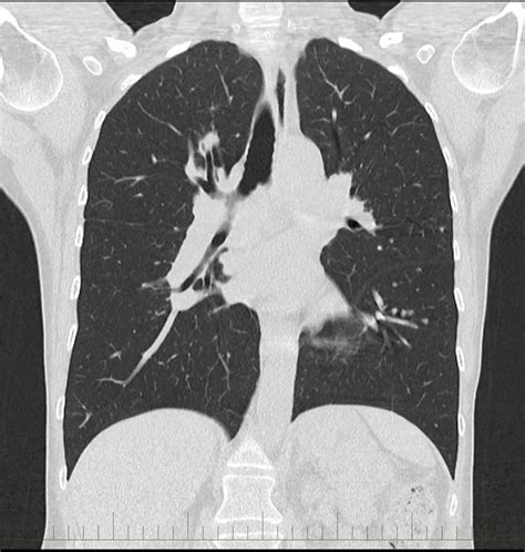 Chest CT Scan - Melbourne Radiology