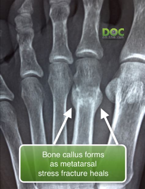 Myths About X-rays And Running Injuries