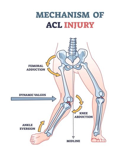 ACL vs. PCL - GulfPhysio - UAE's Online Physiotherapy Store