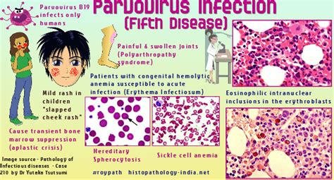 Pathology of Parvovirus B19 Infection (Fifth Disease) - Dr Sampurna Roy MD