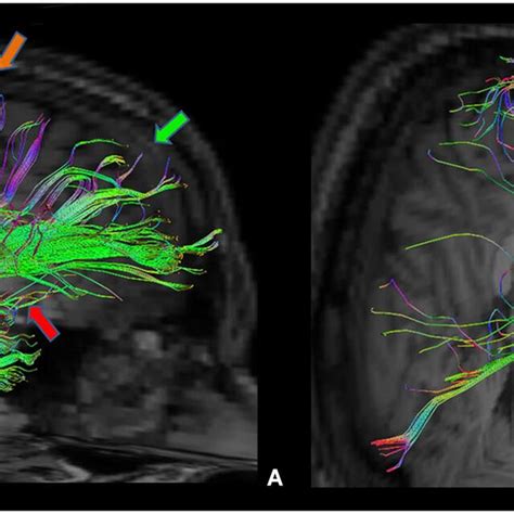 Amygdala And Hypothalamus Mri