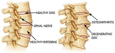 Cervical Osteoarthritis (Spondylosis) Treatment Texas