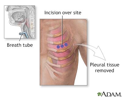 Open pleural biopsy Information | Mount Sinai - New York