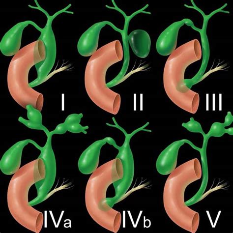 Choledochocele Types