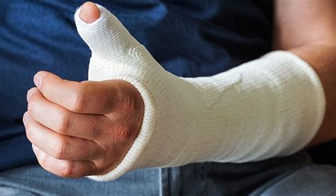 Types Of Casts: Plaster Casts, Synthetic Casts, Splints, 56% OFF