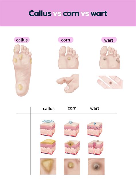 How to remove a corn from your foot? [Corn removal surgery near me]