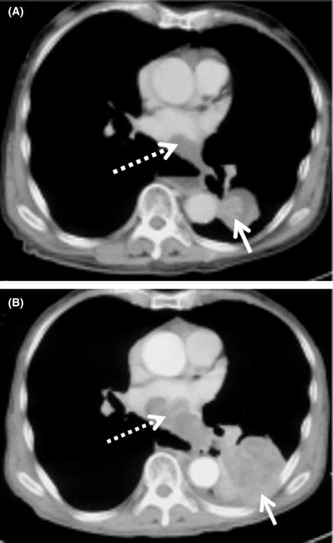 (A) The initial contrast‐enhanced axial plane CT thorax in the soft ...