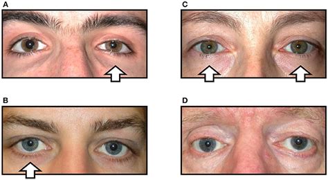 Frontiers | Apraclonidine Is Better Than Cocaine for Detection of ...