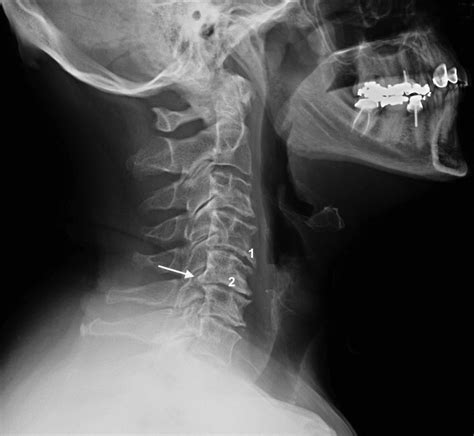 OSTEOARTHRITIS, CERVICAL | Hand Surgery Source