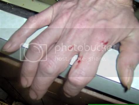 Worst Snake Bite Pictures, Images & Photos | Photobucket