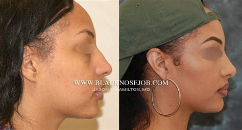 African American Rhinoplasty Los Angeles Black Nose Surgery