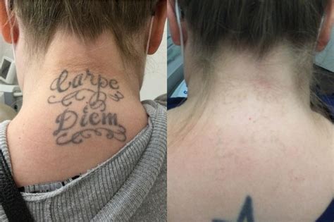 Everything You Need To Know About Tattoo Removal Before And After ...