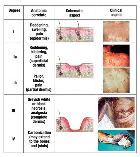 Burn Injury Treatments :: Houston, Harris County, Texas :: Houston ...