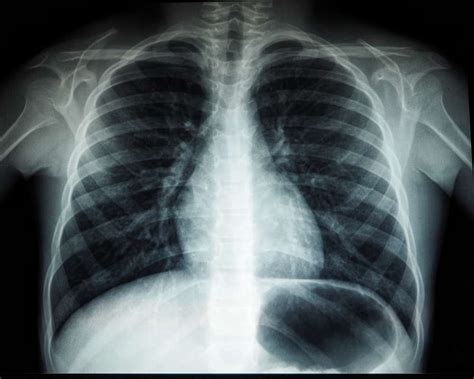 Normal Chest X Ray Labeled