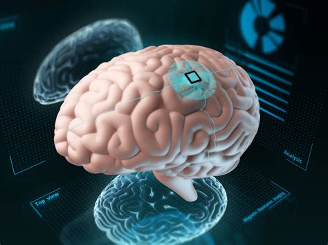 Can Implanted Computer Chips Cure Depression? | Mind Matters