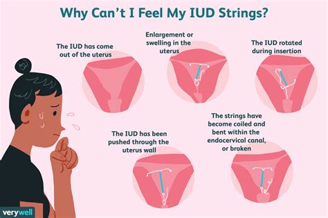 What to Do If Your IUD Strings Seem to Be Missing