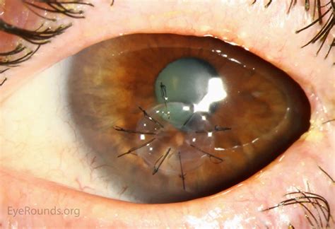 Cornea transplant types, success rate, vision after transplant ...