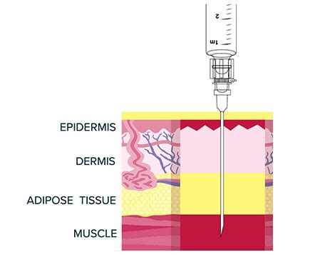 VIVITROL® Administration - Directions for Use | HCP