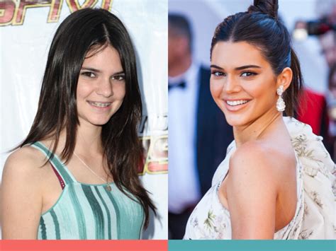 Orthodontics Australia | 6 Celebrities With Braces Before and After ...