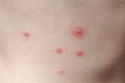 Childhood rashes - myDr.com.au