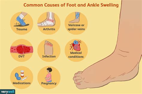 Common Causes of Foot and Ankle Swelling