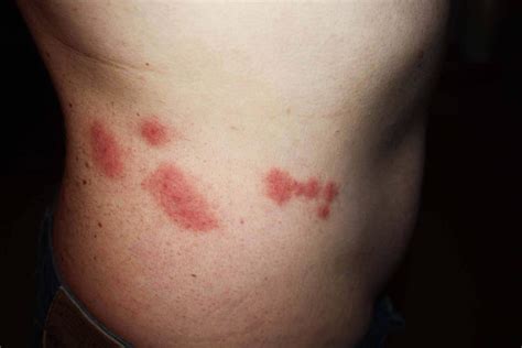 Bed Bug Bites | Bed Bugs Bites | Bed Bug Bites Pictures | Do Bed Bug ...