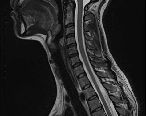 MRI Spine - Paediatic MRI Series