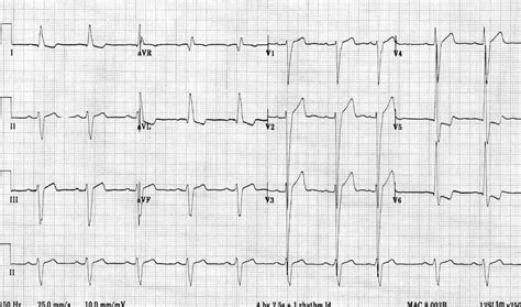 Left Ventricular Hypertrophy (LVH) • LITFL • ECG Library Diagnosis