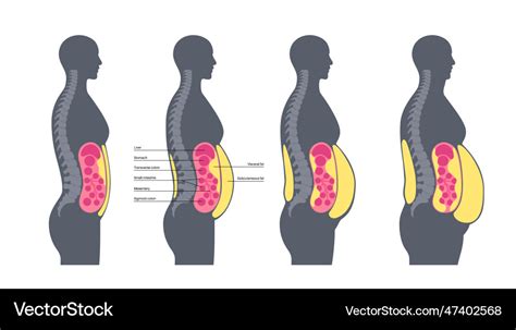 Visceral fat diagram Royalty Free Vector Image