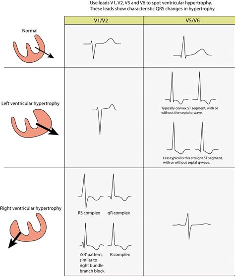 The ECG in left ventricular hypertrophy (LVH): criteria and ...