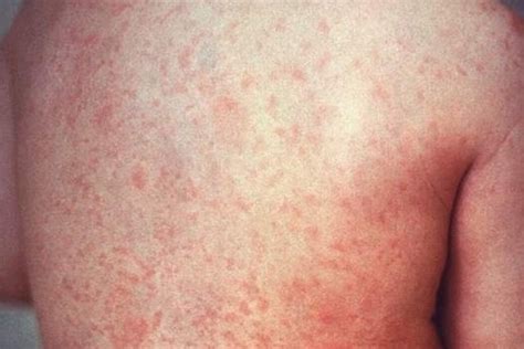 Red Spots On Skin: 19 Causes & What They Look Like (with Pictures ...