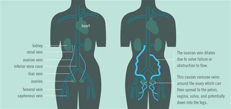 Pelvic Venous Congestion Syndrome