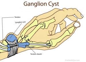 17 Best images about Ganglion Cyst on Pinterest | Stripes, Places and ...