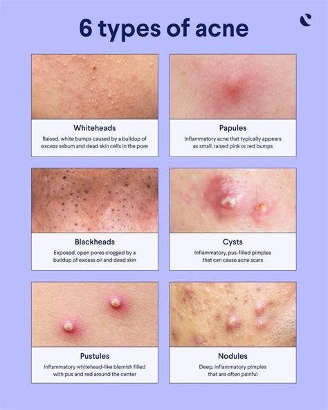 Types of acne: clogged pores, whiteheads, blackheads, cysts | Curology ...