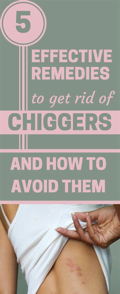 5 Effective Remedies To Get Rid Of Chiggers And How To Avoid Them ...