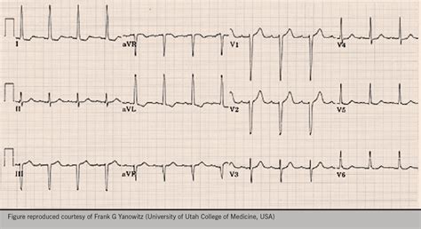 Hypertension, LVH, echo…and stuff - The British Journal of Cardiology