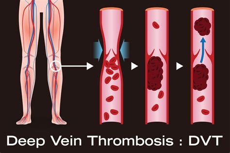 Deep Vein Thrombosis - Dr Toby Cohen