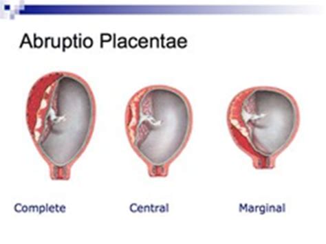 Abruptio placenta Flashcards | Quizlet