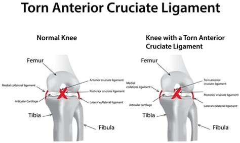 ACL Sprain or Tear | Fort Collins Back Pain | Spine Correction Center ...