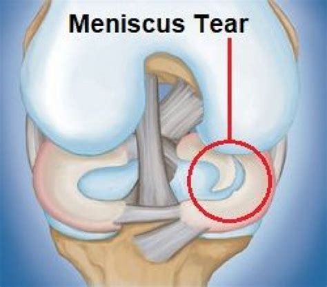 Meniscus tears are common knee injuries. Find out about causes symptoms ...