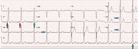 delta wave ecg