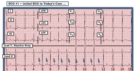 ECG Interpretation: ECG Blog #255 (18) — Why AV Dissociation?