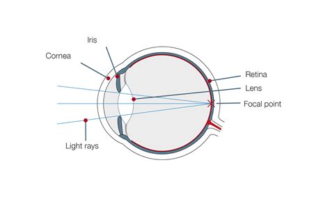 Astigmatism - EuroEyes