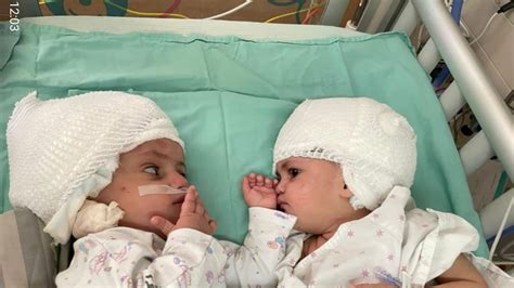 Conjoined twins joined at the head are separated after 12-hour surgery ...