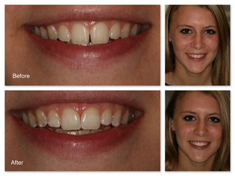 Tooth Colored Fillings Gallery - Dr. Jack M. Hosner, D.D.S.