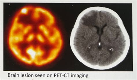 PET-CT Brain Scans - Hollywood Diagnostics