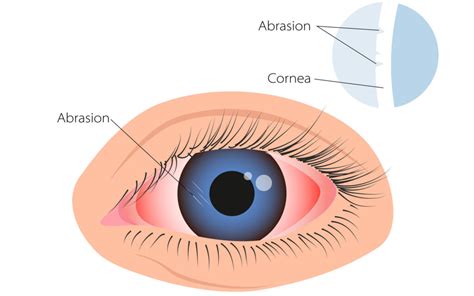 First Aid for a Scratched Eye - Vision Center