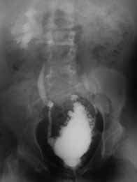 Typical appearance of neuropathic bladder with prominent trabeculations ...