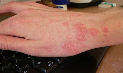 Scabies rash Look Like & Causes10